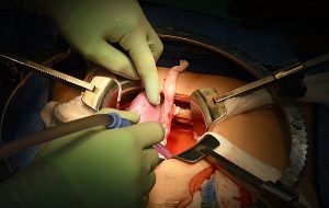 Rekor! Beyin Ölümü Gerçekleşen Adama Nakledilen Domuz Böbreği Hala Çalışıyor