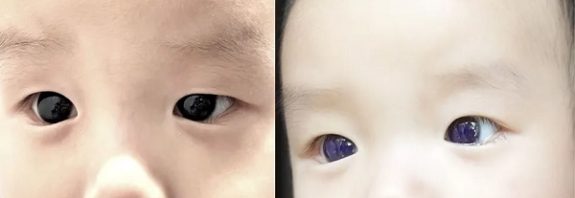 Infant's dark-brown eyes suddenly turn indigo blue after COVID-19 antiviral treatment. But why?