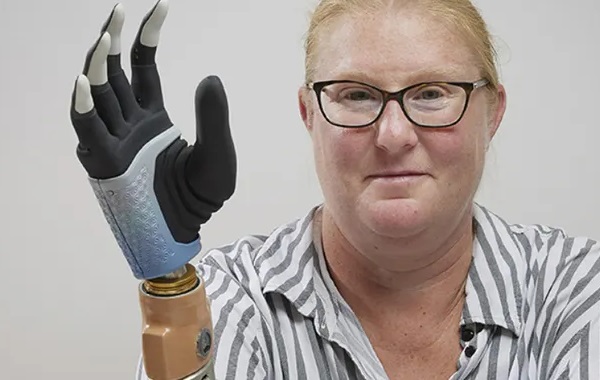 This Woman's Bionic Arm Is Melded To Her Bones And Nervous System
