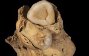 Scientists Find a Tumor Made of Teeth in The Pelvis of an Ancient Egyptian