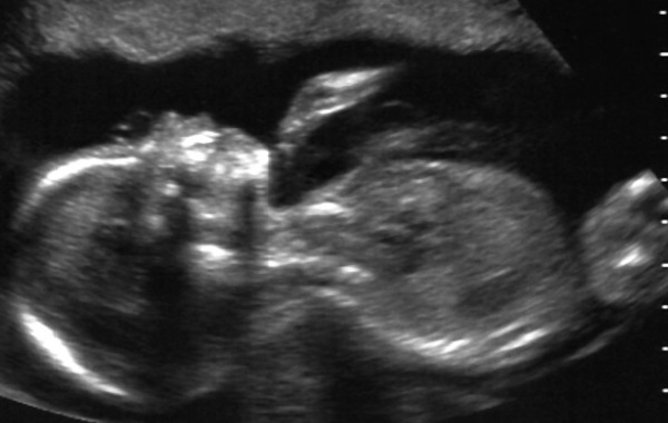 1 in 50 Million Chance: US Woman With Rare Double Uterus Is Pregnant in Both