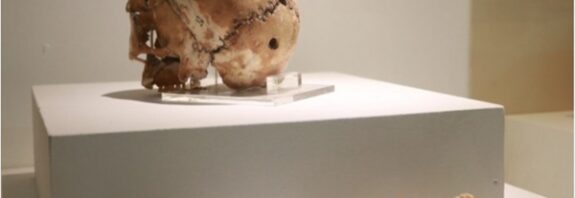 Dünyanın İlk Beyin Ameliyatı