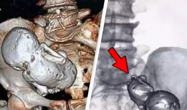 Yaşlılıkta Sıra Dışı Bir Mucize: 73 Yaşındaki Kadının Vücudundaki 'Taş Bebek' Nasıl Oluştu