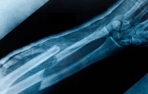 Kırık Kemikleri Daha Hızlı İyileştirebilen Yeni Bir Bandaj Geliştirildi