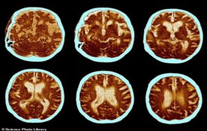 Scientists find human brain has grown by whopping 7% since 1930... but there are signs IQs have gone backwards in recent years
