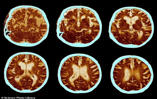 Scientists find human brain has grown by whopping 7% since 1930... but there are signs IQs have gone backwards in recent years