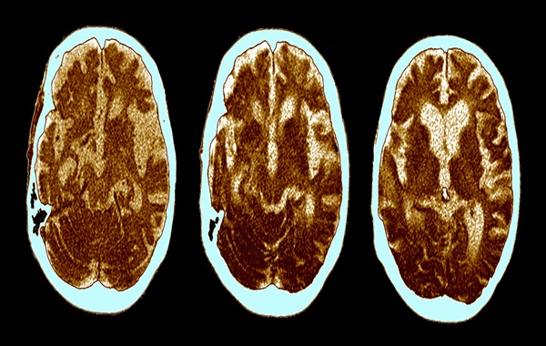 The Hidden Cause of Alzheimer's May Have Been Identified a Century Ago