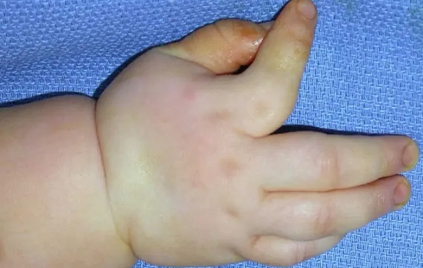 Neden Bazı Çocuklar Çarpık Parmaklarla Doğar?