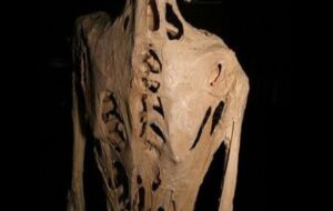 New Hope Discovered For Children Whose Soft Tissues Slowly Turn to Bone