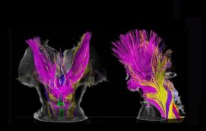 MRI Taramaları Bilincin Beyindeki Şaşırtıcı Aşamalarını Ortaya Koyuyor
