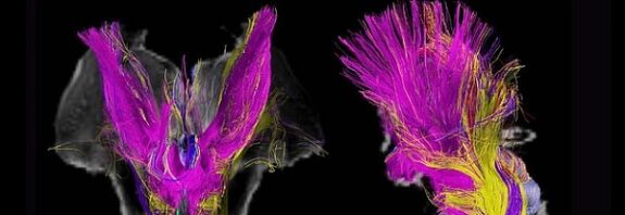 MRI Taramaları Bilincin Beyindeki Şaşırtıcı Aşamalarını Ortaya Koyuyor