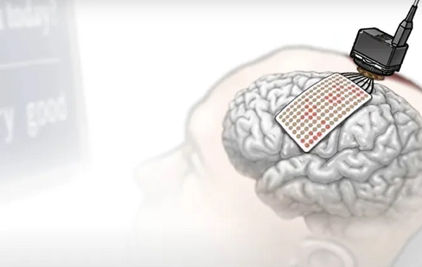 İlk Kez Bir Beyin-Bilgisayar Arayüzü Aracılığıyla Konuşmayı Gerçek Zamanlı Olarak Çözmek Mümkün Oldu