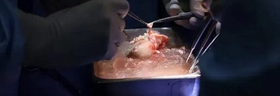 Dünyada İlk Kez Bir Hastaya Domuz Karaciğeri Nakledildi