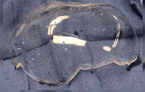 Dünyanın İlk Şeffaf Plastik Kafatası İmplantı İnsan Beynine Bir Pencere Açıyor