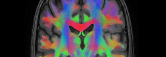 Brain Circuitry Discovered That Could Explain How Placebos Relieve Pain