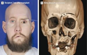 World's First Eye And Face Transplant: One Year Later, Eye Now Responds To Light