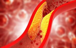Cardiovascular breakthrough: Nanoparticle therapy cuts plaque buildup in arteries