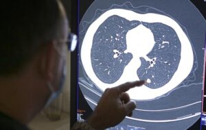 Decoding Super-Survivors: Why Some Overcome Aggressive Cancers