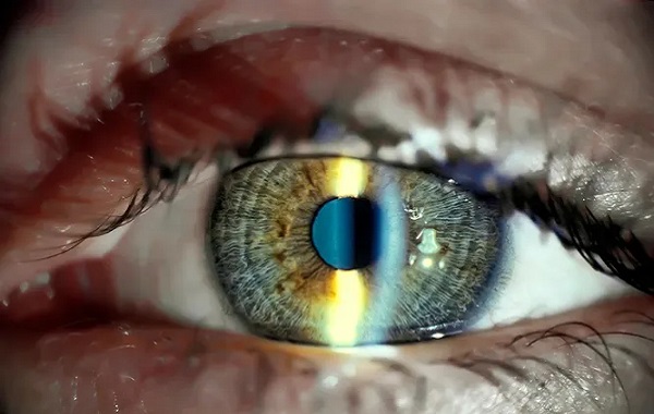 Donör Kök Hücreleri Kullanarak Korneayı Onarmayı Başardılar