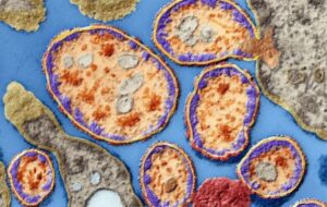 Virolog Halassi, Denenmemiş Bir Yöntemle Kendi Kanserini Tedavi Etti