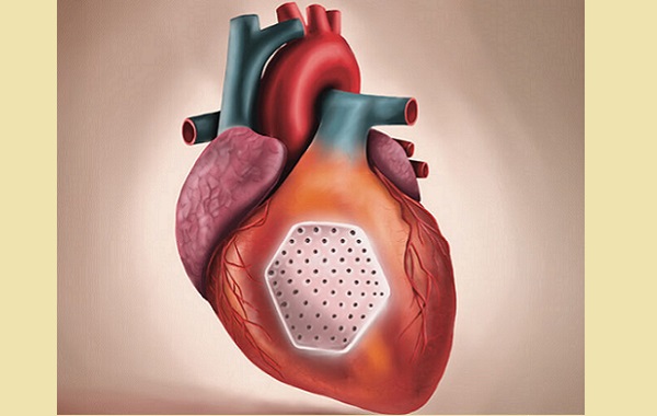 Erken Aşamadaki Mühendislik Ürünü Bir Kas Yaması Kalp Yetmezliğini Düzeltti