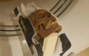 Kafatası Analizi Vikinglerin Yüz Hastalıklarından Muzdarip Olduğunu Gösteriyor