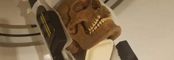 Kafatası Analizi Vikinglerin Yüz Hastalıklarından Muzdarip Olduğunu Gösteriyor