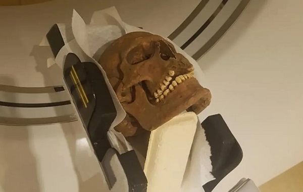 Kafatası Analizi Vikinglerin Yüz Hastalıklarından Muzdarip Olduğunu Gösteriyor