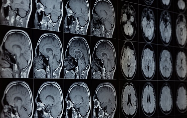 Our Brains Contain Lithium—and Its Loss Might Help Drive Alzheimer’s, Study Finds