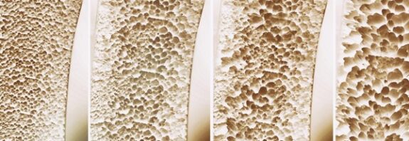 Osteoporozla Savaşta