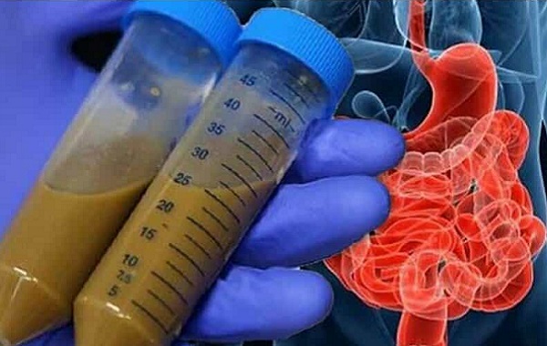 Tek Bir Dışkı Nakli Yıllarca Sağlık Yararı Sağlar