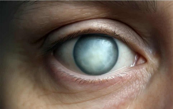 Fütüristik Göz İmplantı, Korneayı Atlıyarak Görüntüleri Doğrudan Retinaya İletiyor