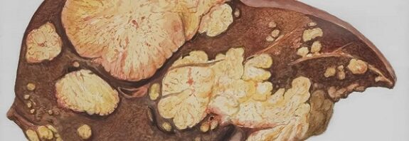 Alkolün Yağlı Karaciğer Hastalığını Nasıl Tetiklediği Bulundu