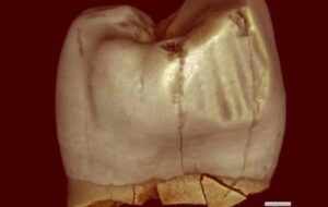 Antik Dişlerdeki İzler