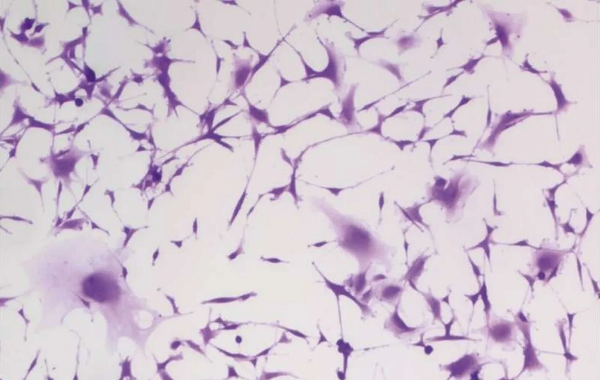 Hipertansiyon İlacı Beyin Kanserini Nasıl Durdurabilir?