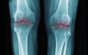 Reversing the Clock: The Revolutionary Stem Cell Breakthrough That Could End Osteoarthritis Forever