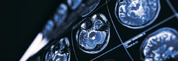 Ya Kanser Alzheimer Hastalığı İçin Yeni Tedavilerin Anahtarıysa?