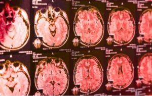 Yeni Bir Kan Testi, Parkinson Hastalığını Titremeler Ortaya Çıkmadan Önce Tespit Edebilir