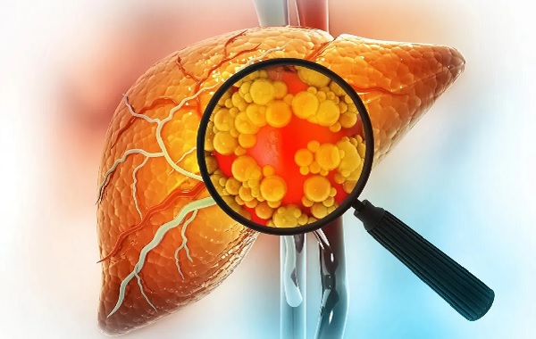 Yağlı Beslenme Karaciğeri Yeniden Programlıyor ve Kanser Riskini Artırıyor