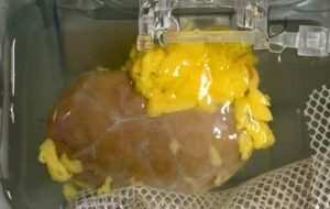 No More Blood Type Barriers: New "Universal Kidney" Could End the Long Wait for Transplants Forever