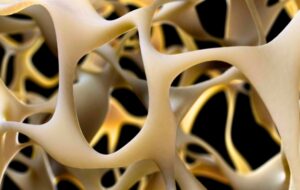 New Genetic Breakthrough: Can We Finally "Turn Back the Clock" on Osteoporosis?