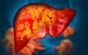 Mayo Clinic discovers rare gene mutation that causes fatty liver disease