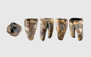 Antik Diş Hekimliği: Altay'da Tedavi İzleri Taşıyan Bir Neandertal Dişi Bulundu