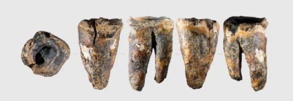 Antik Diş Hekimliği: Altay'da Tedavi İzleri Taşıyan Bir Neandertal Dişi Bulundu