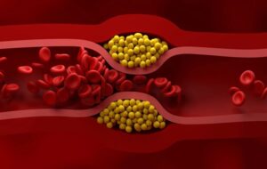 US Cardiologists Issue New Guidelines For How to Manage Cholesterol