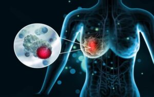 Popular GLP-1 Weight-Loss Drugs Linked to 30% Lower Breast Cancer Risk